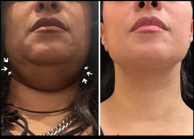 Deep Plane Facelift Before & After Gallery - Patient 294889 - Image 2
