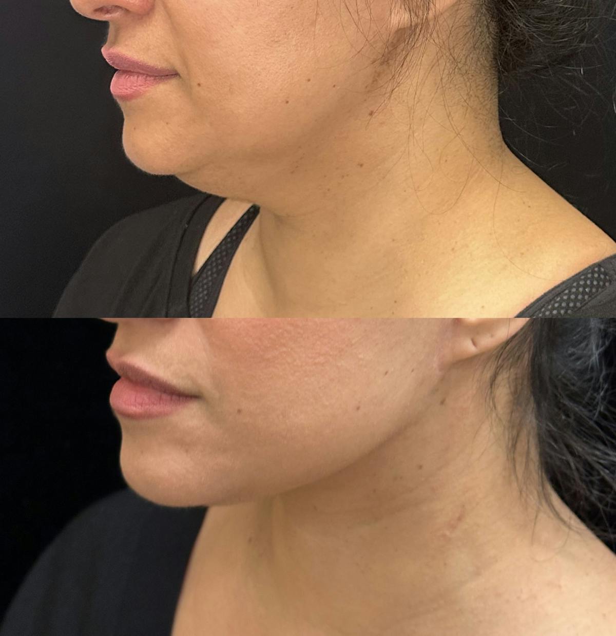 Necklift Before & After Gallery - Patient 288638 - Image 3