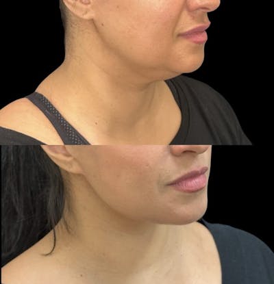 Deep Plane Facelift Before & After Gallery - Patient 294889 - Image 1