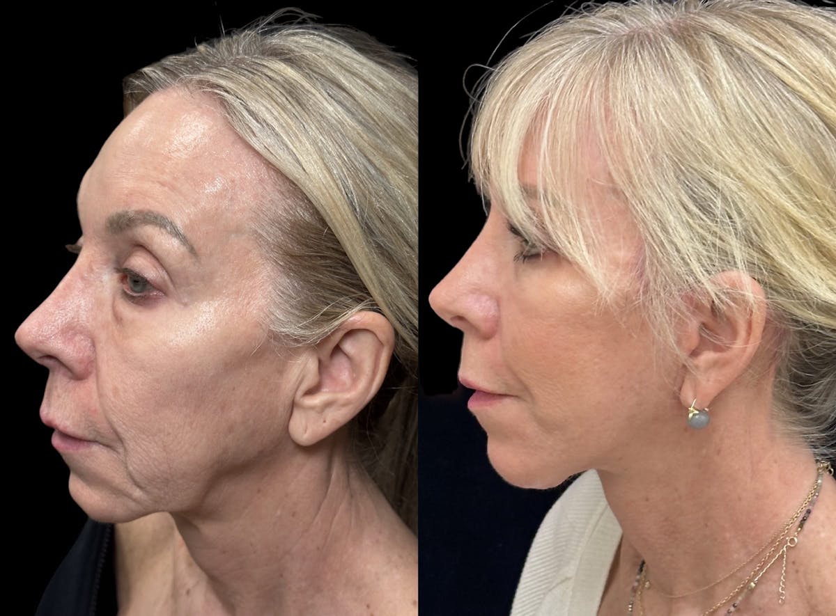 Lower Blepharoplasty Before & After Gallery - Patient 419892 - Image 1