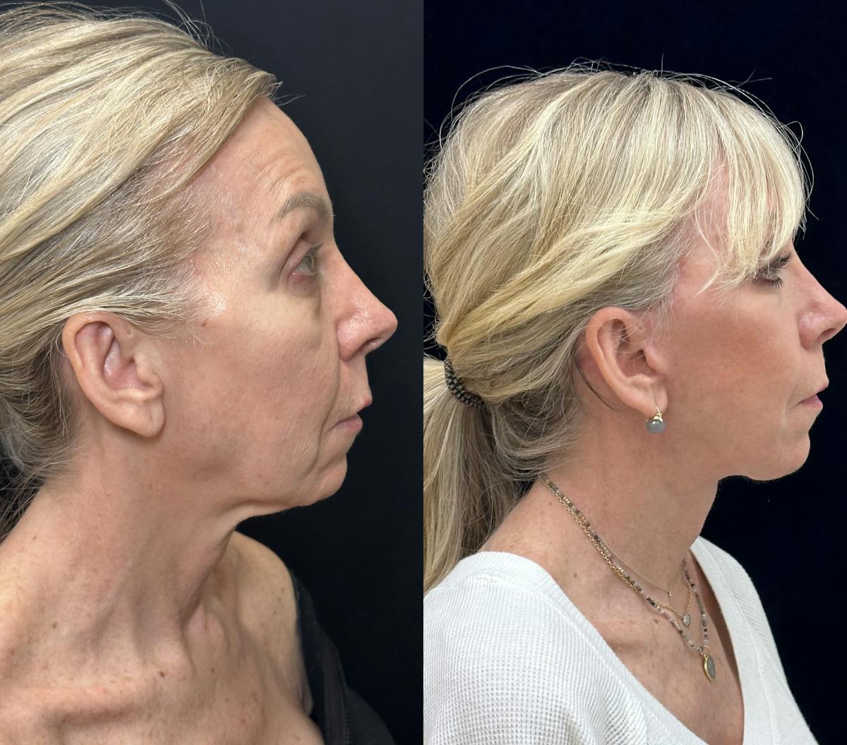 Lower Blepharoplasty Before & After Gallery - Patient 419892 - Image 4