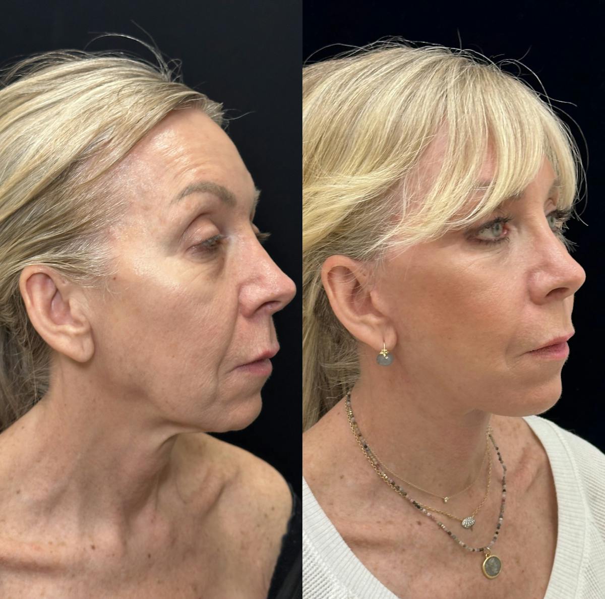 Lower Blepharoplasty Before & After Gallery - Patient 419892 - Image 3
