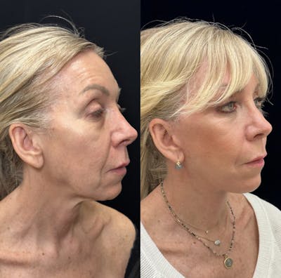 Deep Plane Facelift Before & After Gallery - Patient 382823 - Image 3