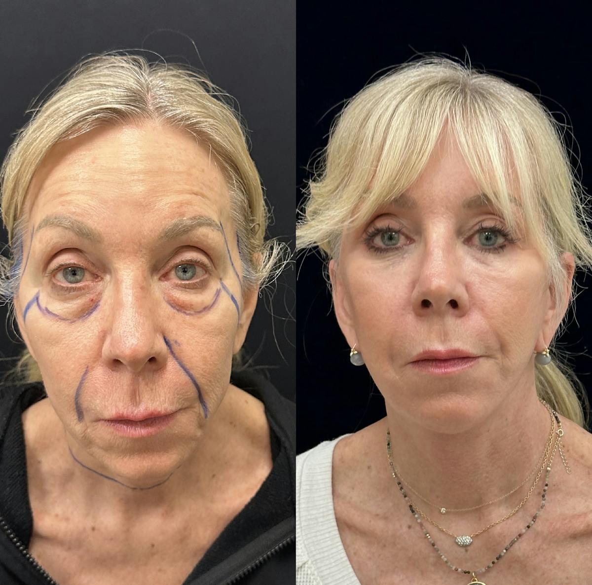 Lower Blepharoplasty Before & After Gallery - Patient 419892 - Image 2