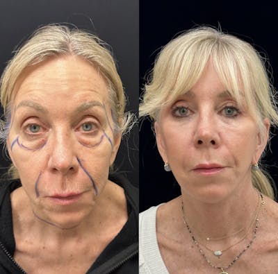 Deep Plane Facelift Before & After Gallery - Patient 382823 - Image 2