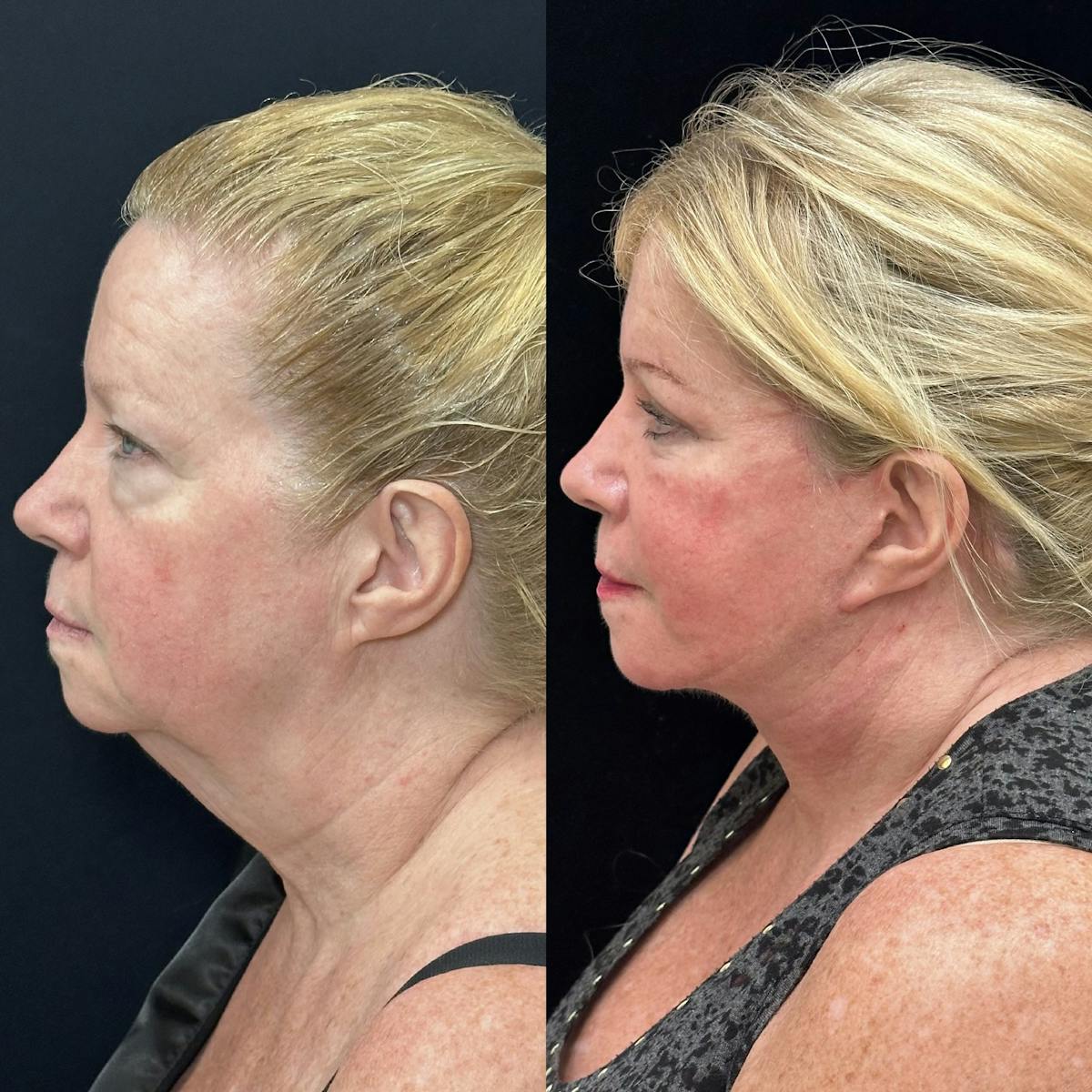 Lower Blepharoplasty Before & After Gallery - Patient 378223 - Image 3