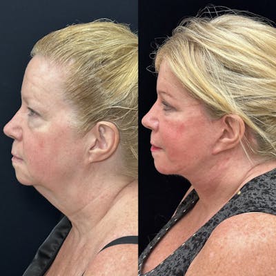 Deep Plane Facelift Before & After Gallery - Patient 654813 - Image 3