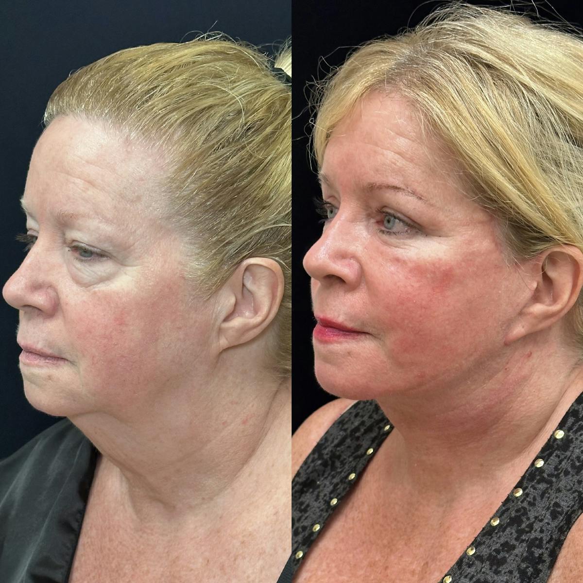 Lower Blepharoplasty Before & After Gallery - Patient 378223 - Image 4