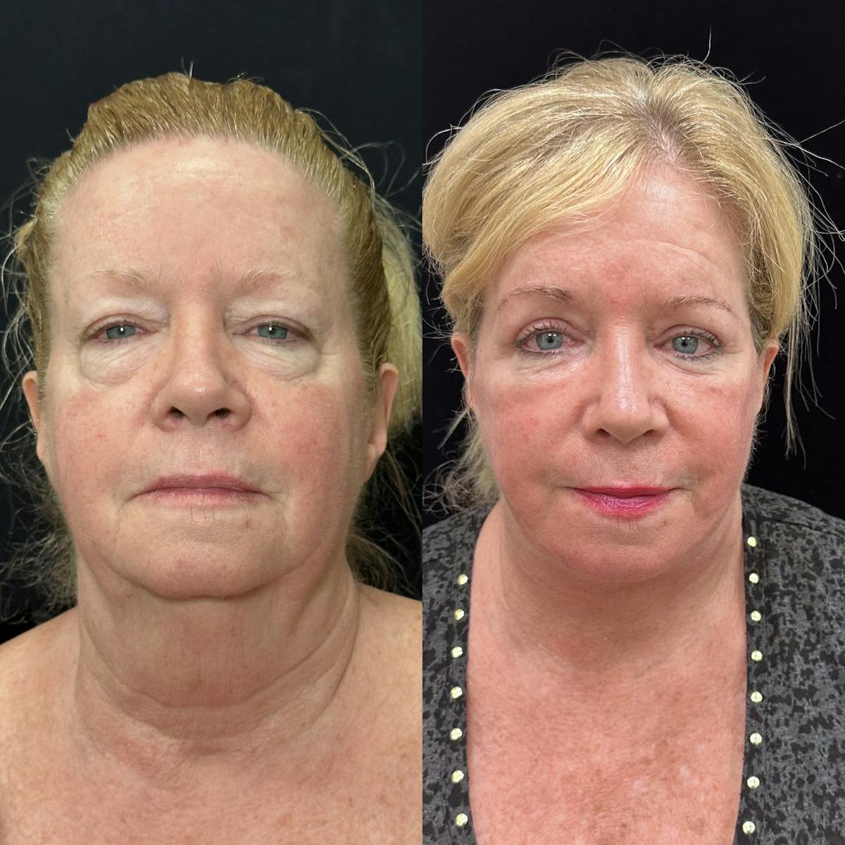 Lower Blepharoplasty Before & After Gallery - Patient 378223 - Image 5