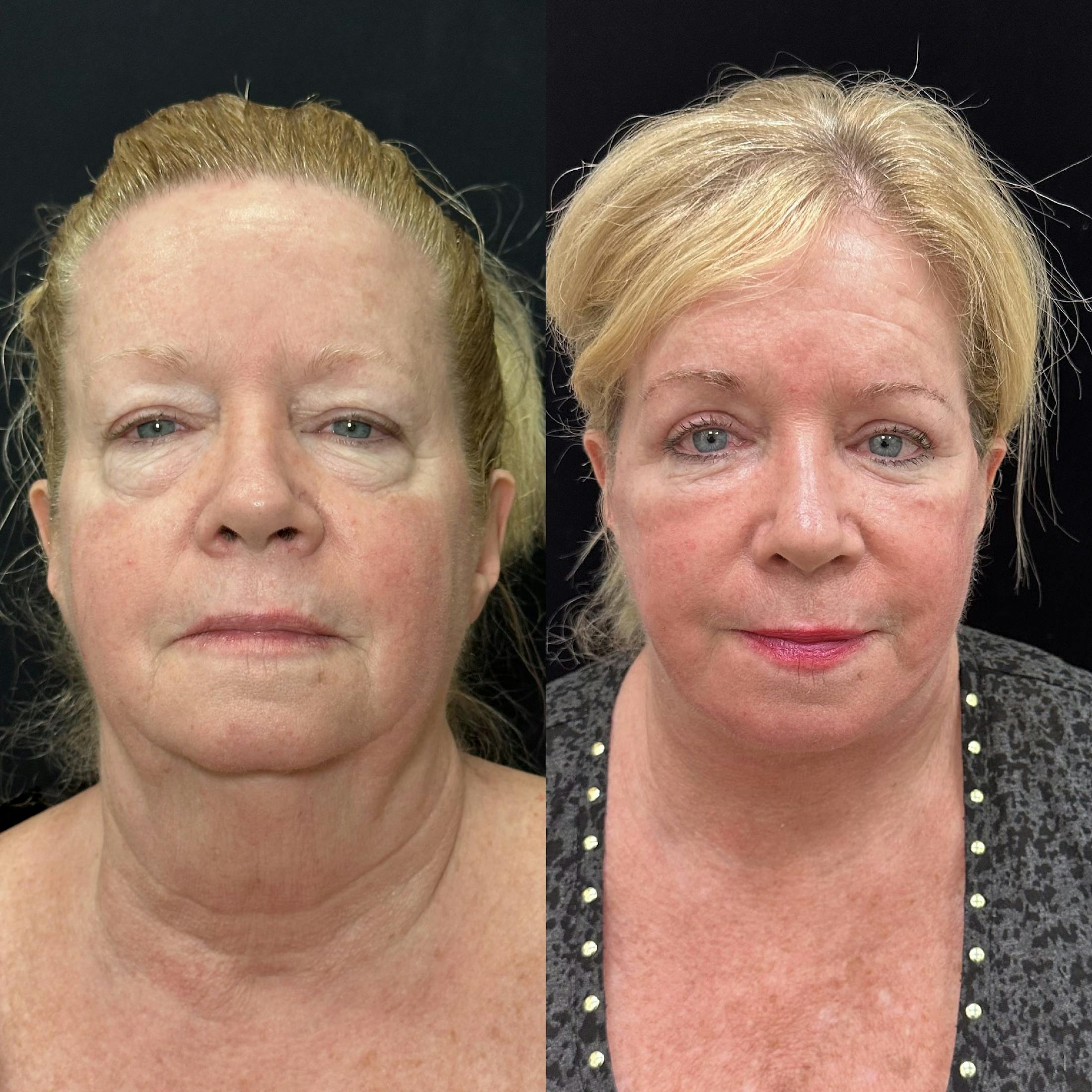 Deep Plane Facelift Before & After Gallery - Patient 654813 - Image 5