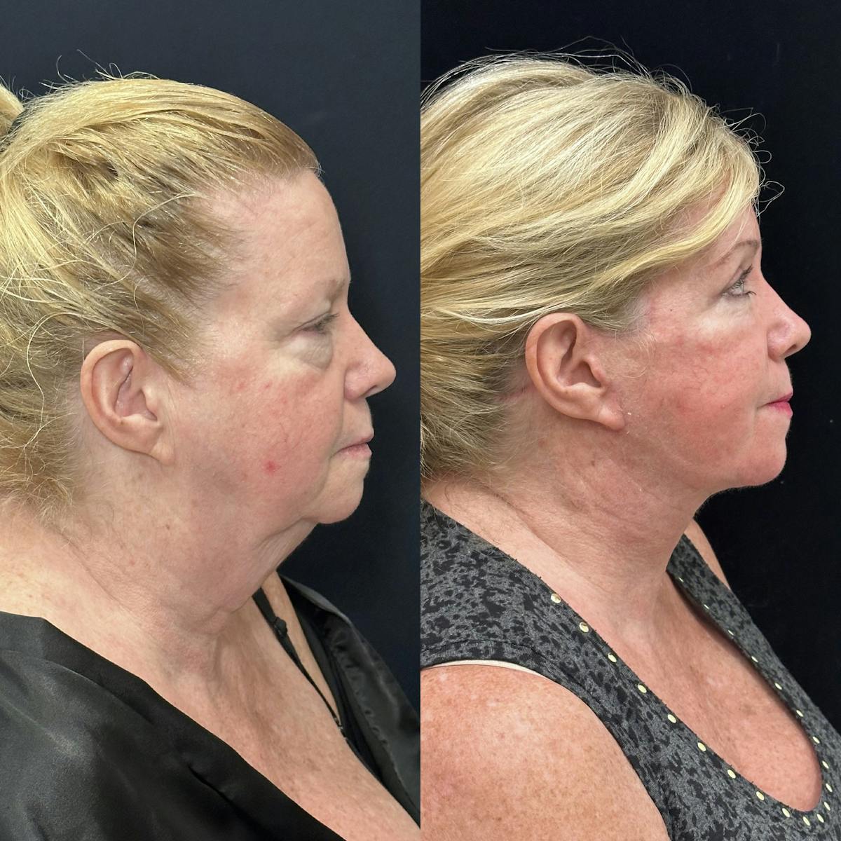Lower Blepharoplasty Before & After Gallery - Patient 378223 - Image 2