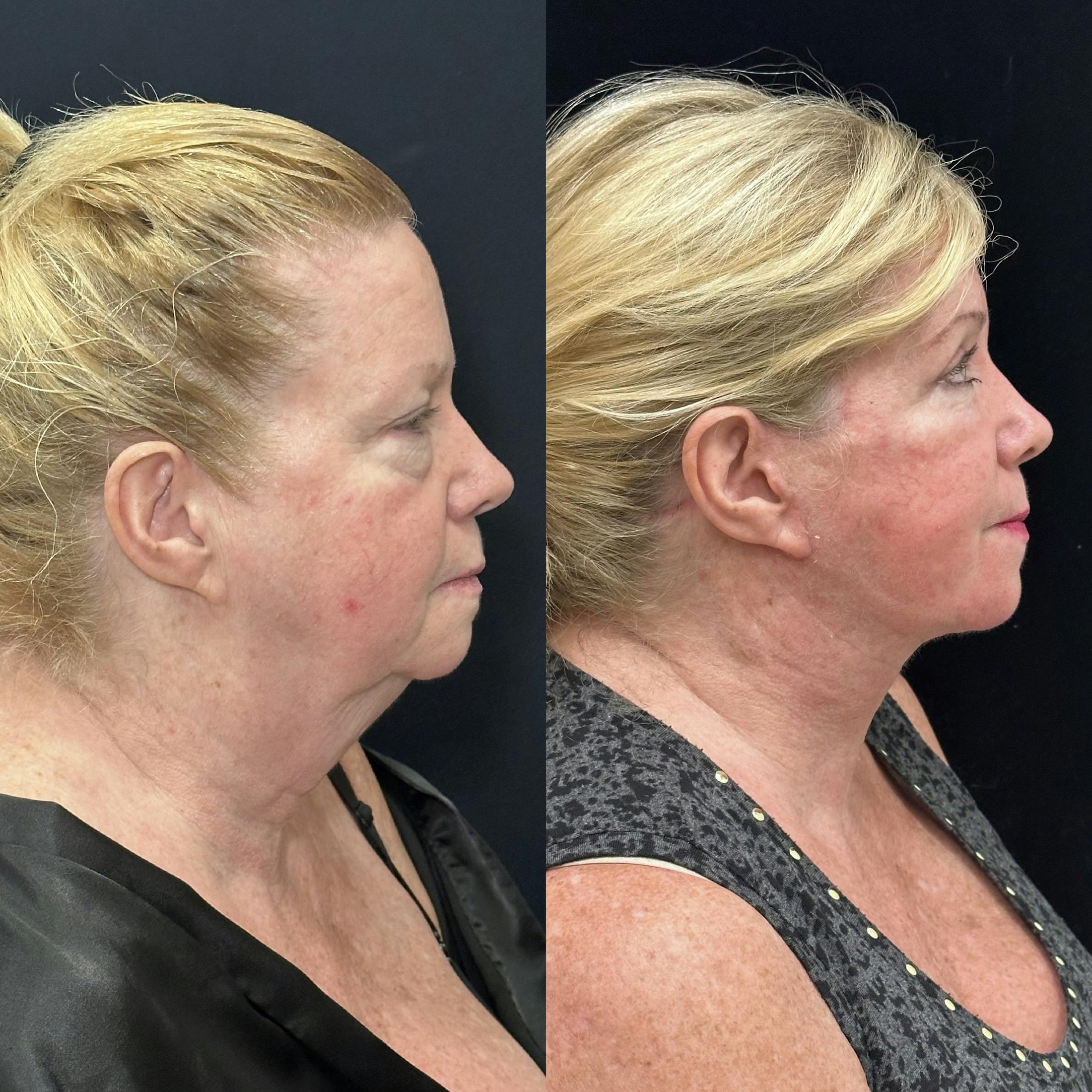 Necklift Before & After Gallery - Patient 287920 - Image 2