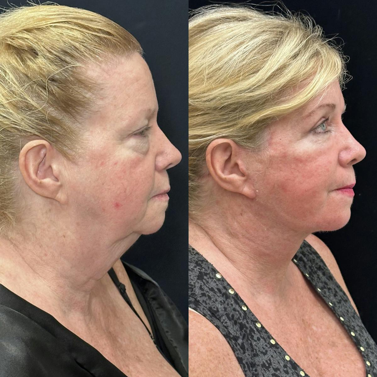 Lower Blepharoplasty Before & After Gallery - Patient 378223 - Image 1