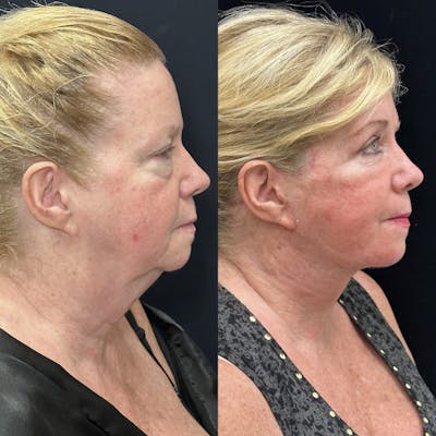 Deep Plane Facelift Before & After Gallery - Patient 654813 - Image 1