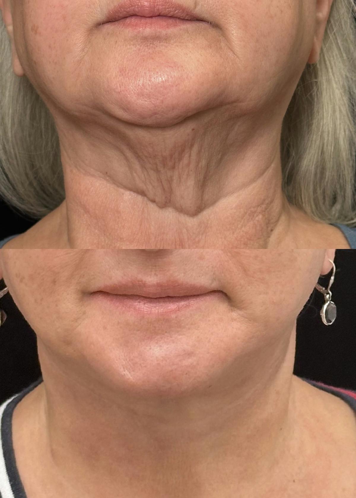Necklift Before & After Gallery - Patient 114521 - Image 3