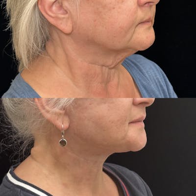 Deep Plane Facelift Before & After Gallery - Patient 227206 - Image 2