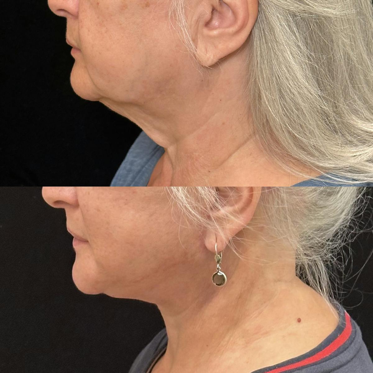 Necklift Before & After Gallery - Patient 114521 - Image 4