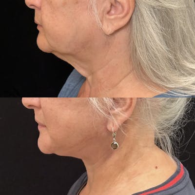 Deep Plane Facelift Before & After Gallery - Patient 227206 - Image 4
