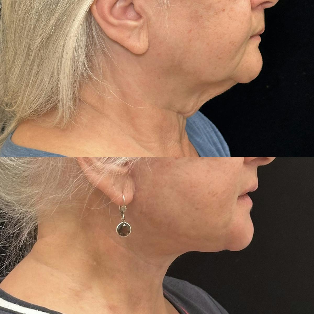 Necklift Before & After Gallery - Patient 114521 - Image 1
