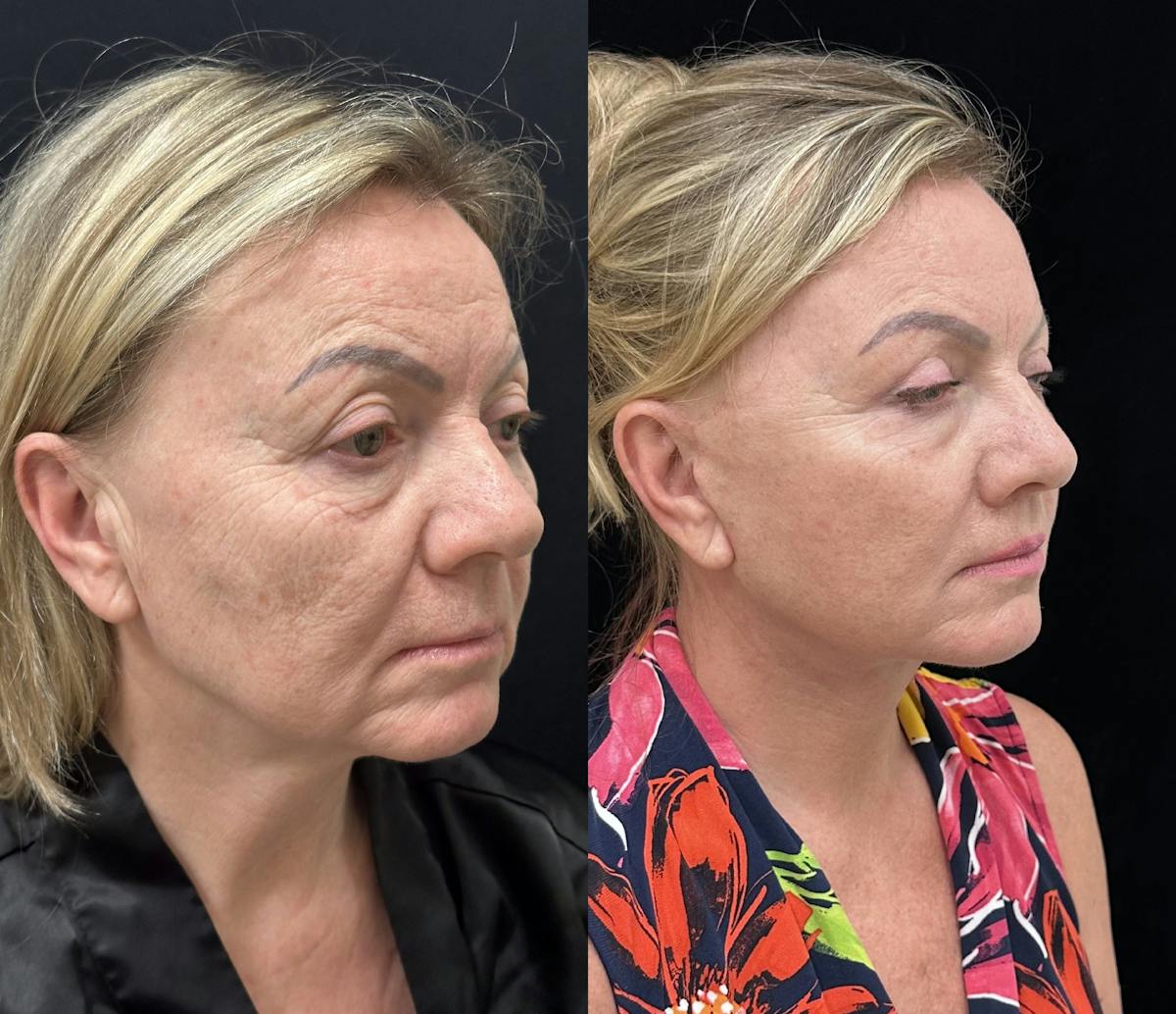  Upper Blepharoplasty Before & After Gallery - Patient 897969 - Image 5