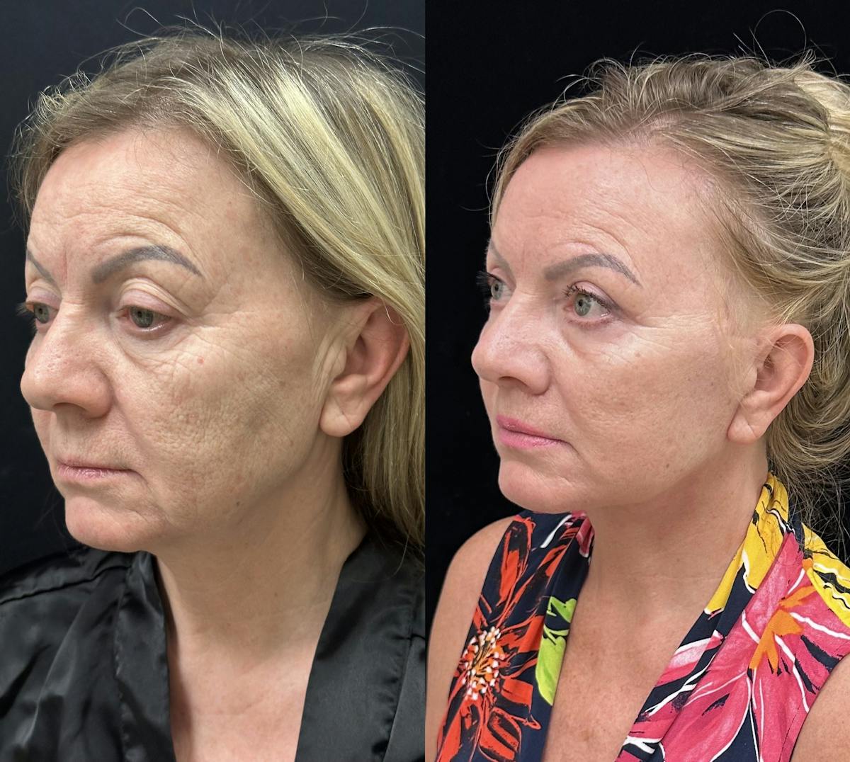  Upper Blepharoplasty Before & After Gallery - Patient 897969 - Image 4