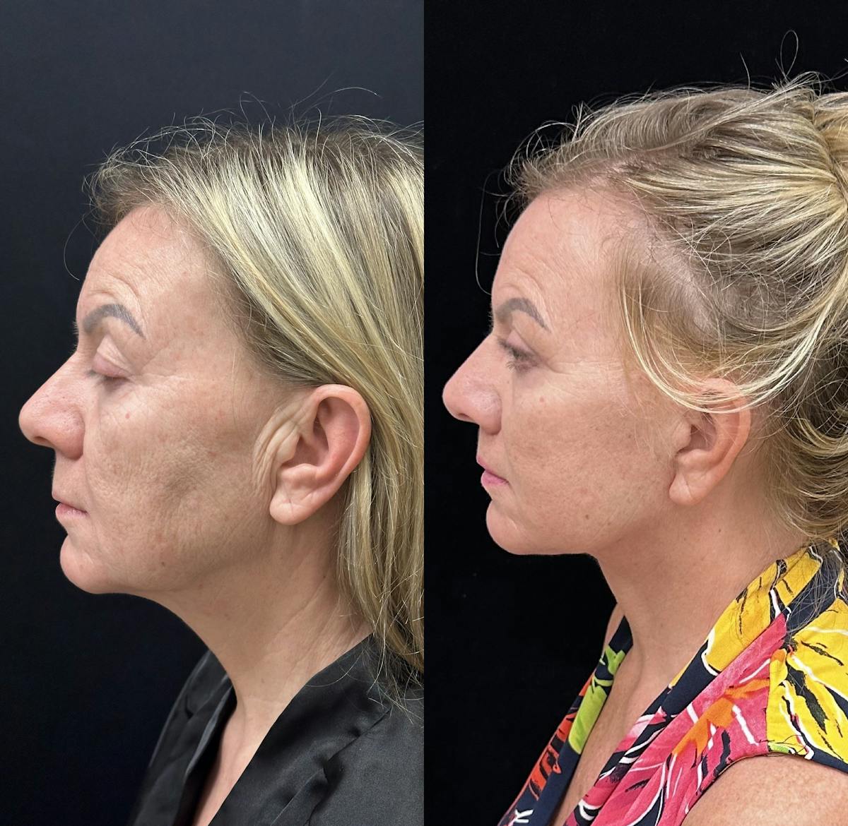  Upper Blepharoplasty Before & After Gallery - Patient 897969 - Image 1