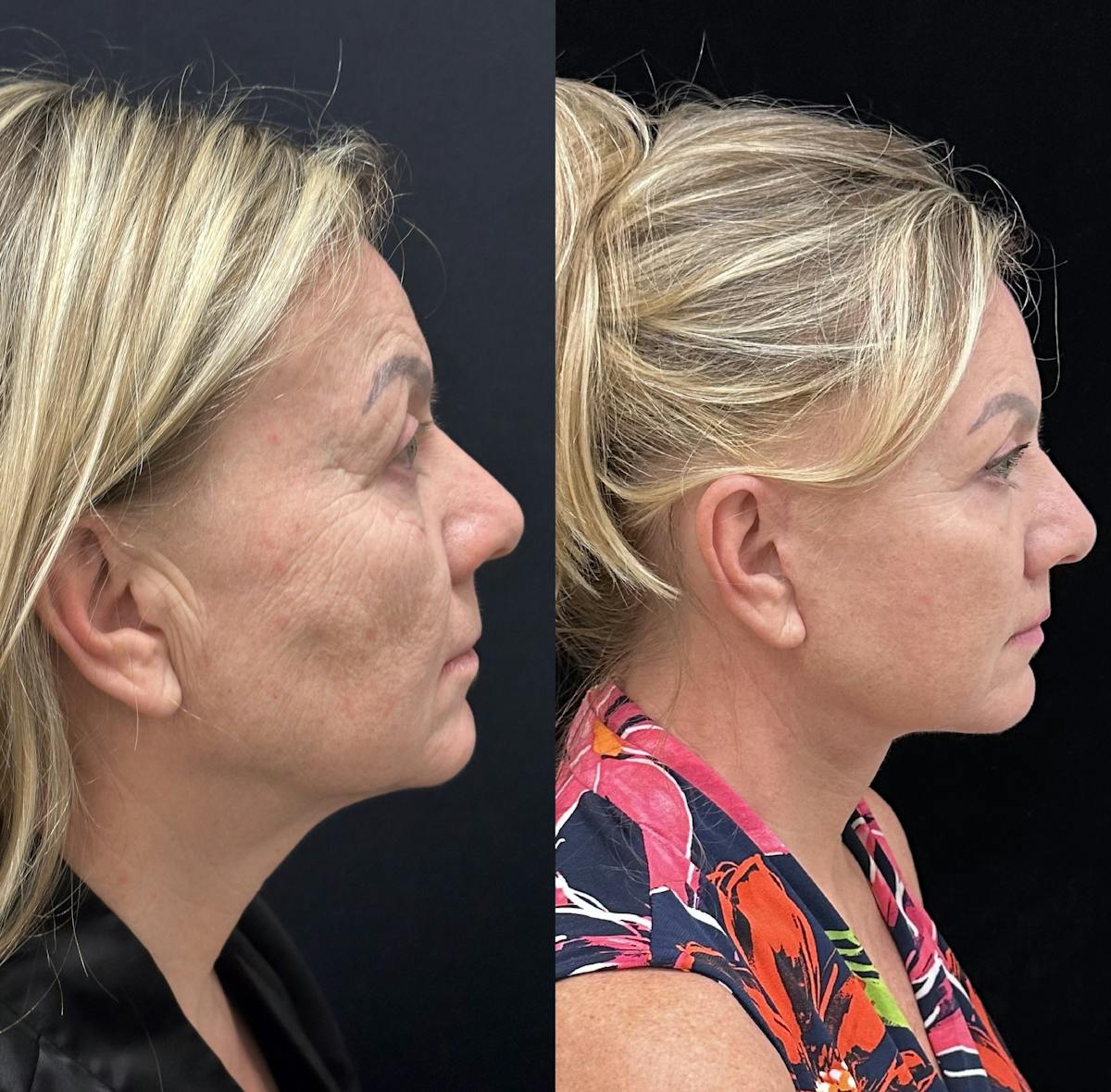  Upper Blepharoplasty Before & After Gallery - Patient 897969 - Image 3