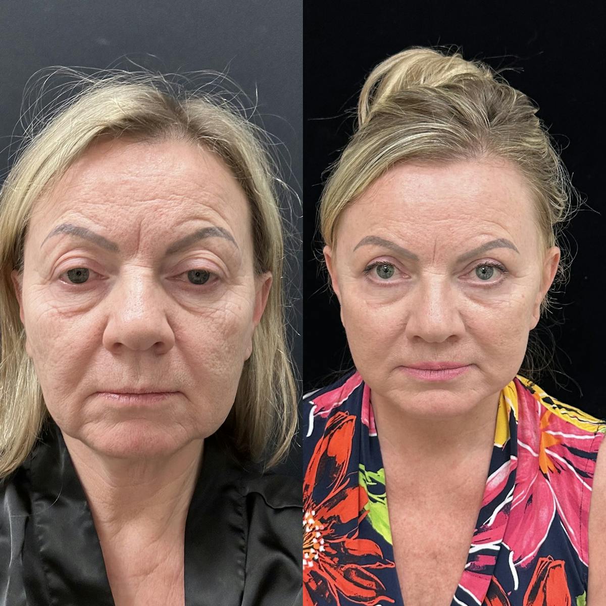  Upper Blepharoplasty Before & After Gallery - Patient 897969 - Image 2