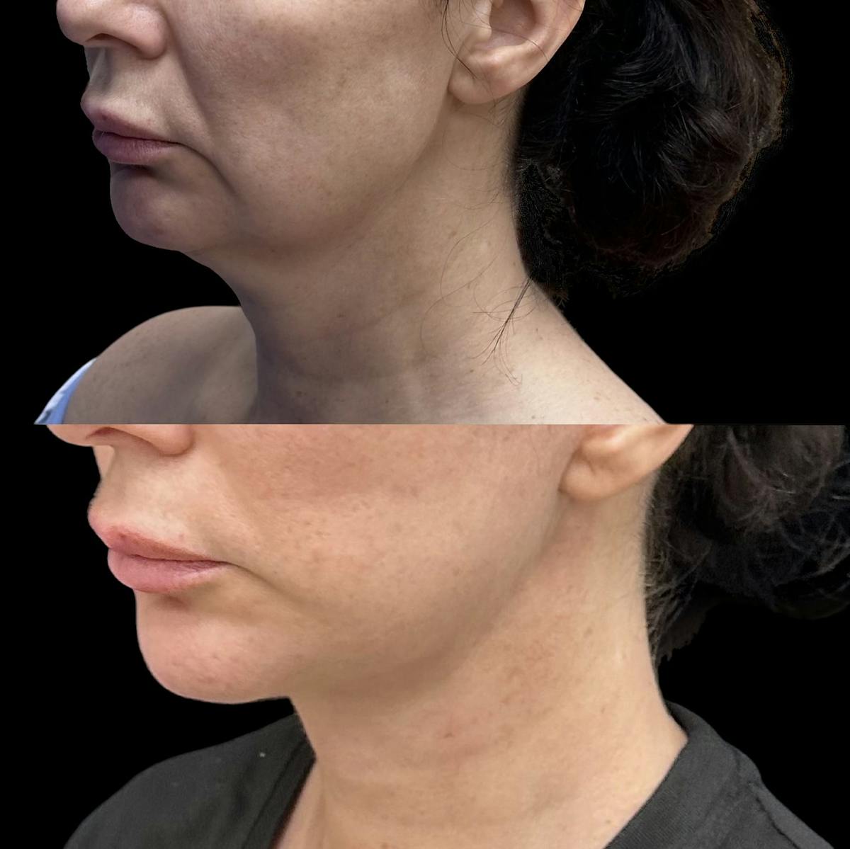 Necklift Before & After Gallery - Patient 134253 - Image 1