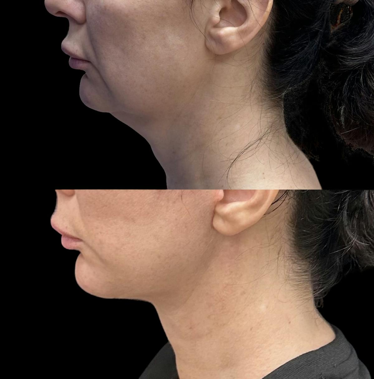 Necklift Before & After Gallery - Patient 134253 - Image 2