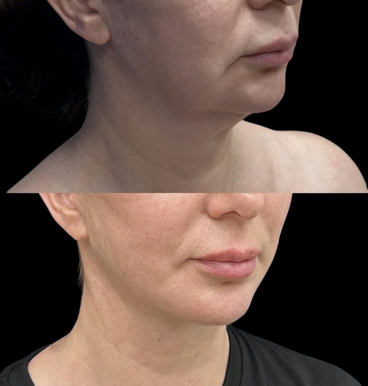 Necklift Before & After Gallery - Patient 134253 - Image 4
