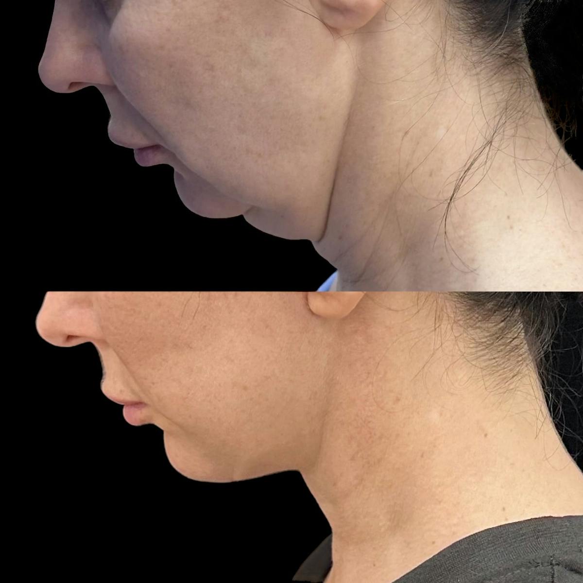 Necklift Before & After Gallery - Patient 134253 - Image 3