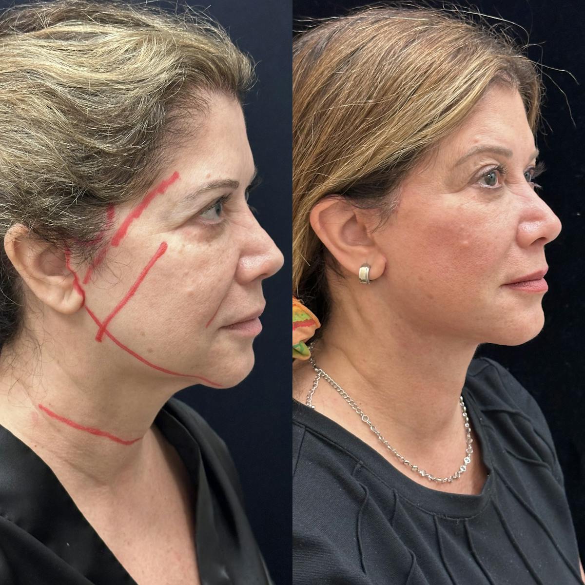 Necklift Before & After Gallery - Patient 162056 - Image 4