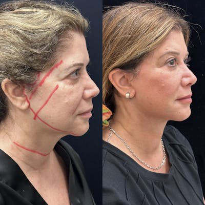 Deep Plane Facelift Before & After Gallery - Patient 367648 - Image 4