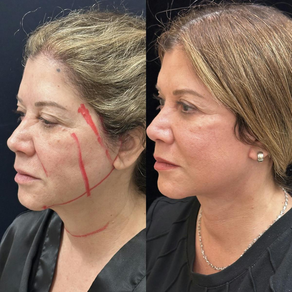 Necklift Before & After Gallery - Patient 162056 - Image 1