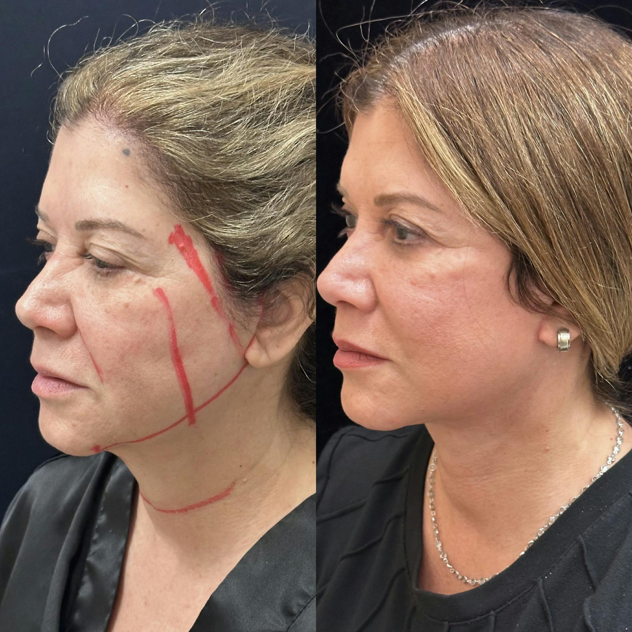 Necklift Before & After Gallery - Patient 162056 - Image 1