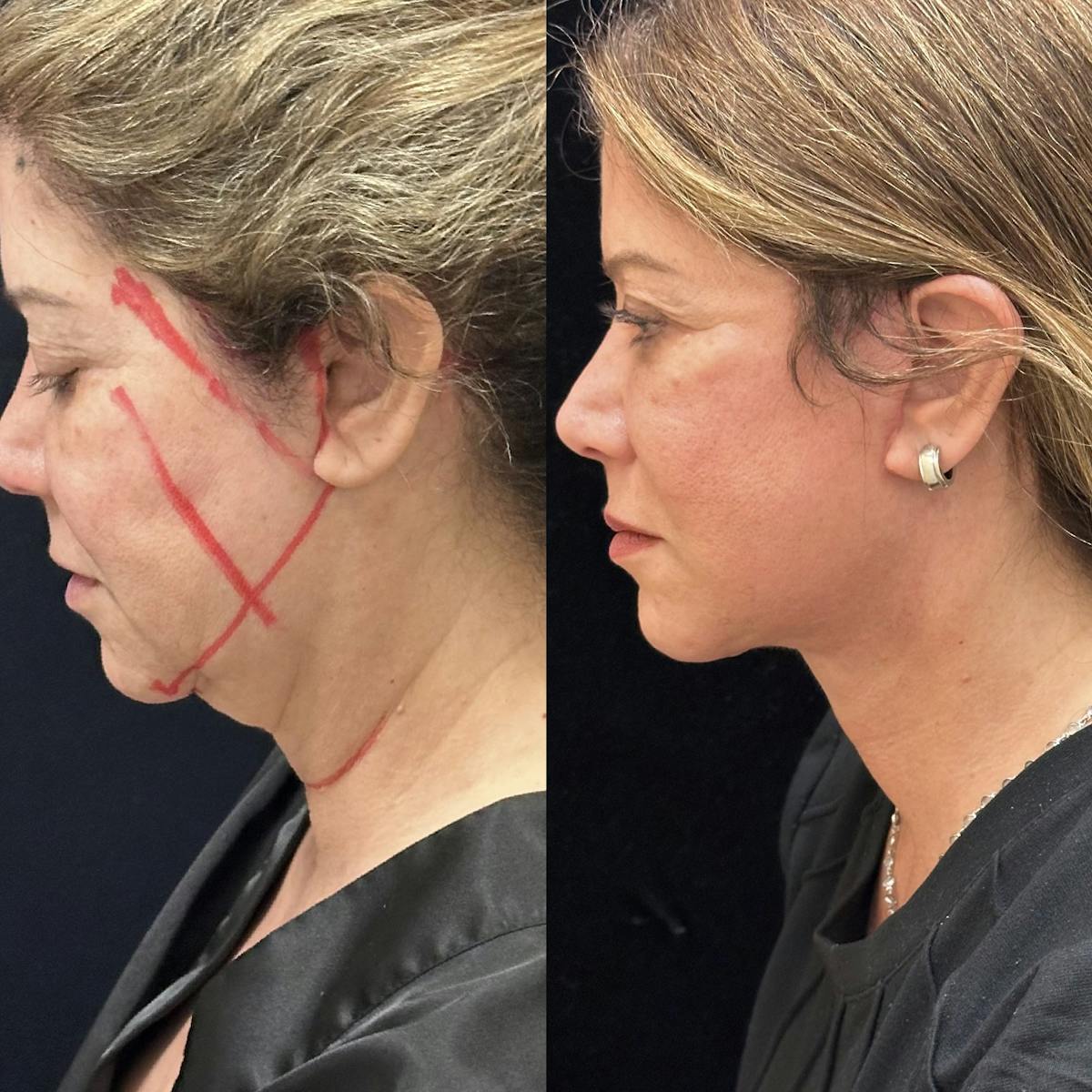 Necklift Before & After Gallery - Patient 162056 - Image 3