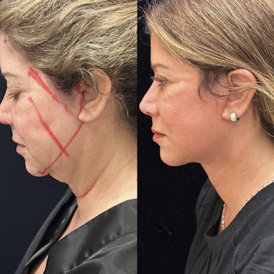 Deep Plane Facelift Before & After Gallery - Patient 367648 - Image 3