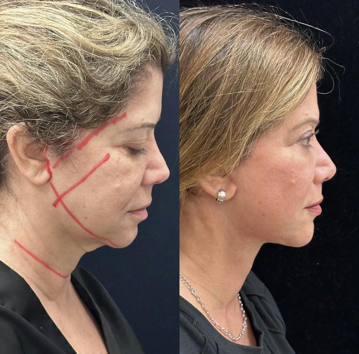 Necklift Before & After Gallery - Patient 162056 - Image 2