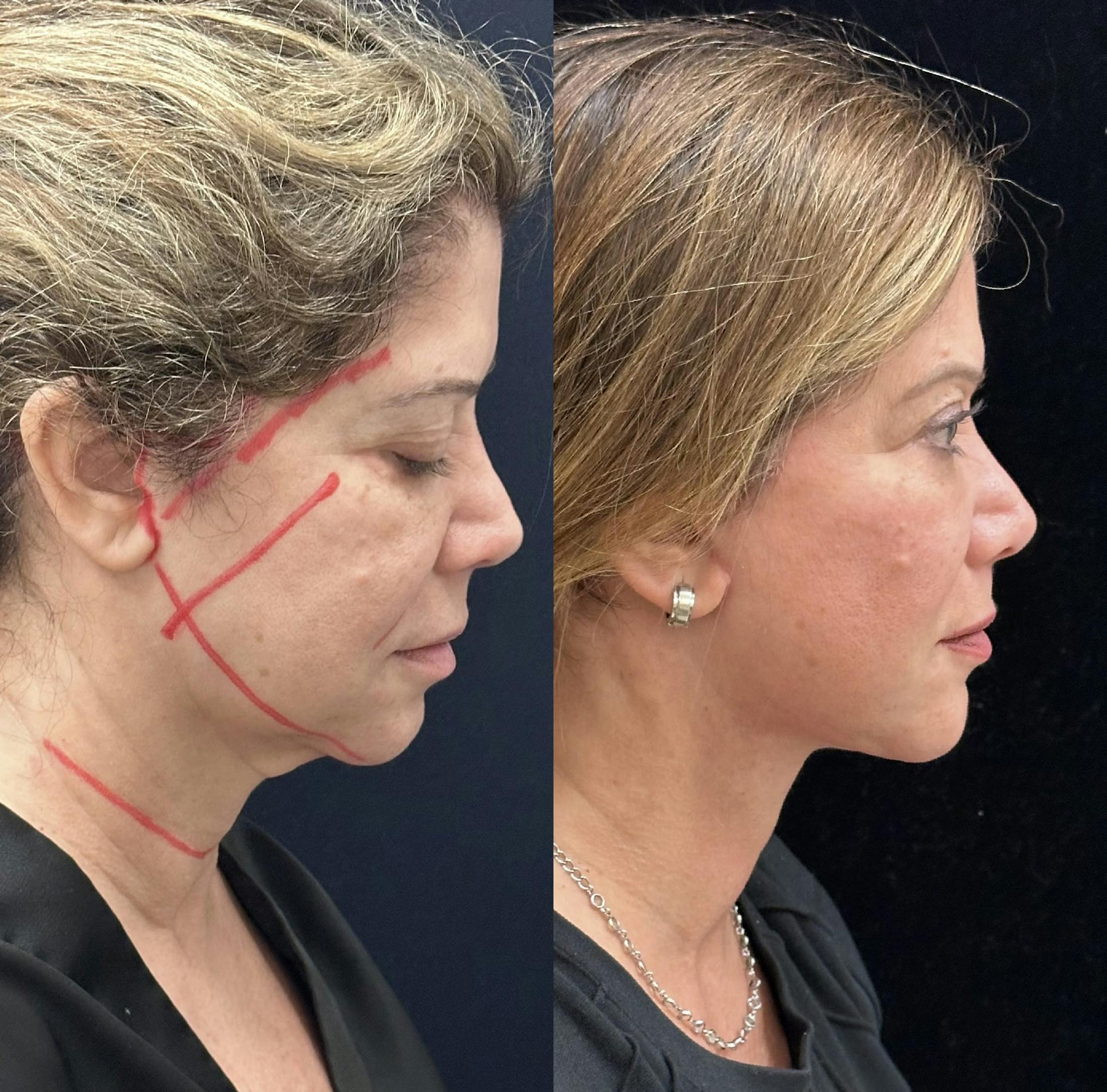 Necklift Before & After Gallery - Patient 162056 - Image 2