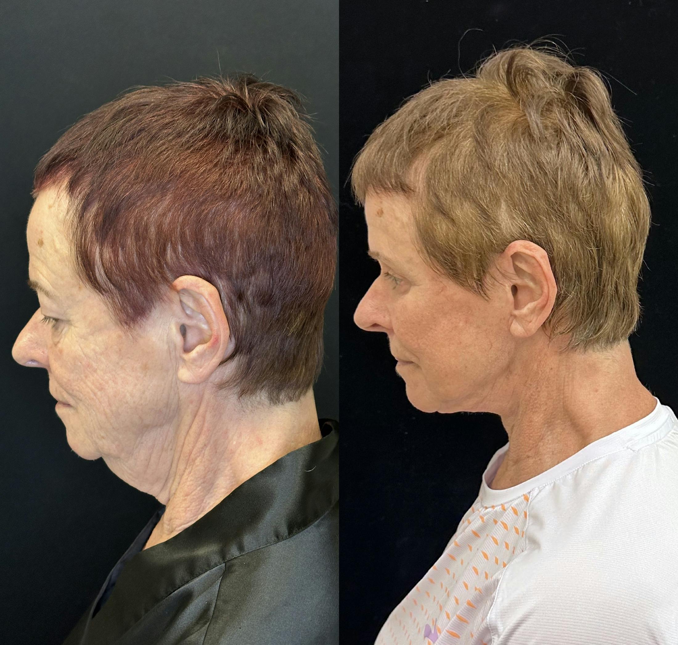 Deep Plane Facelift Before & After Gallery - Patient 579133 - Image 7
