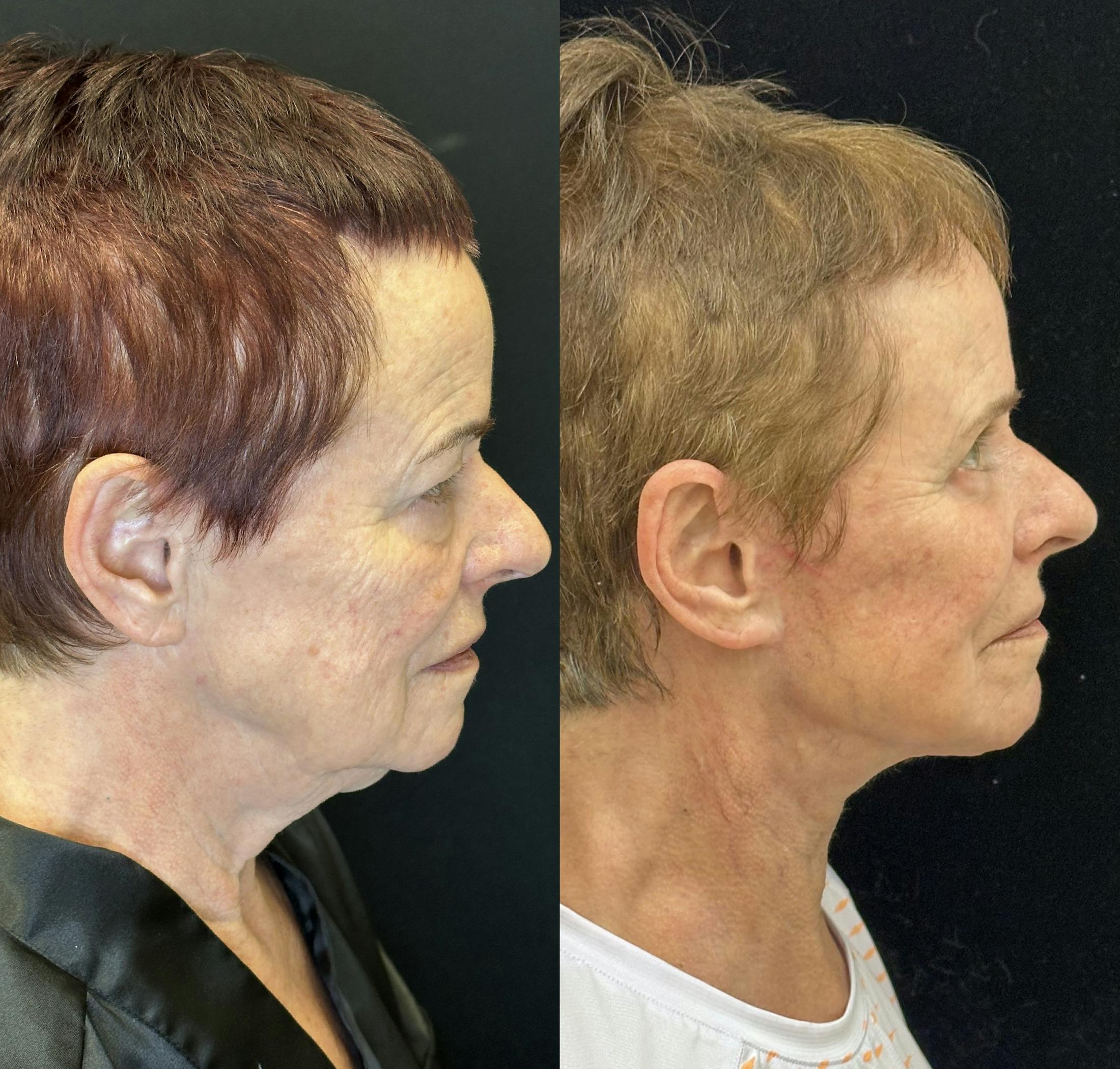 Deep Plane Facelift Before & After Gallery - Patient 579133 - Image 8