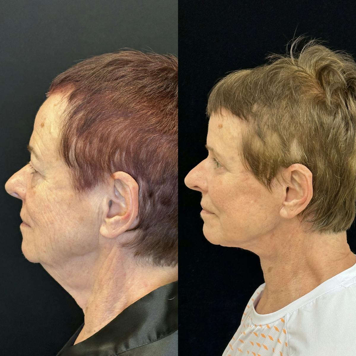 Lower Blepharoplasty Before & After Gallery - Patient 346693 - Image 2