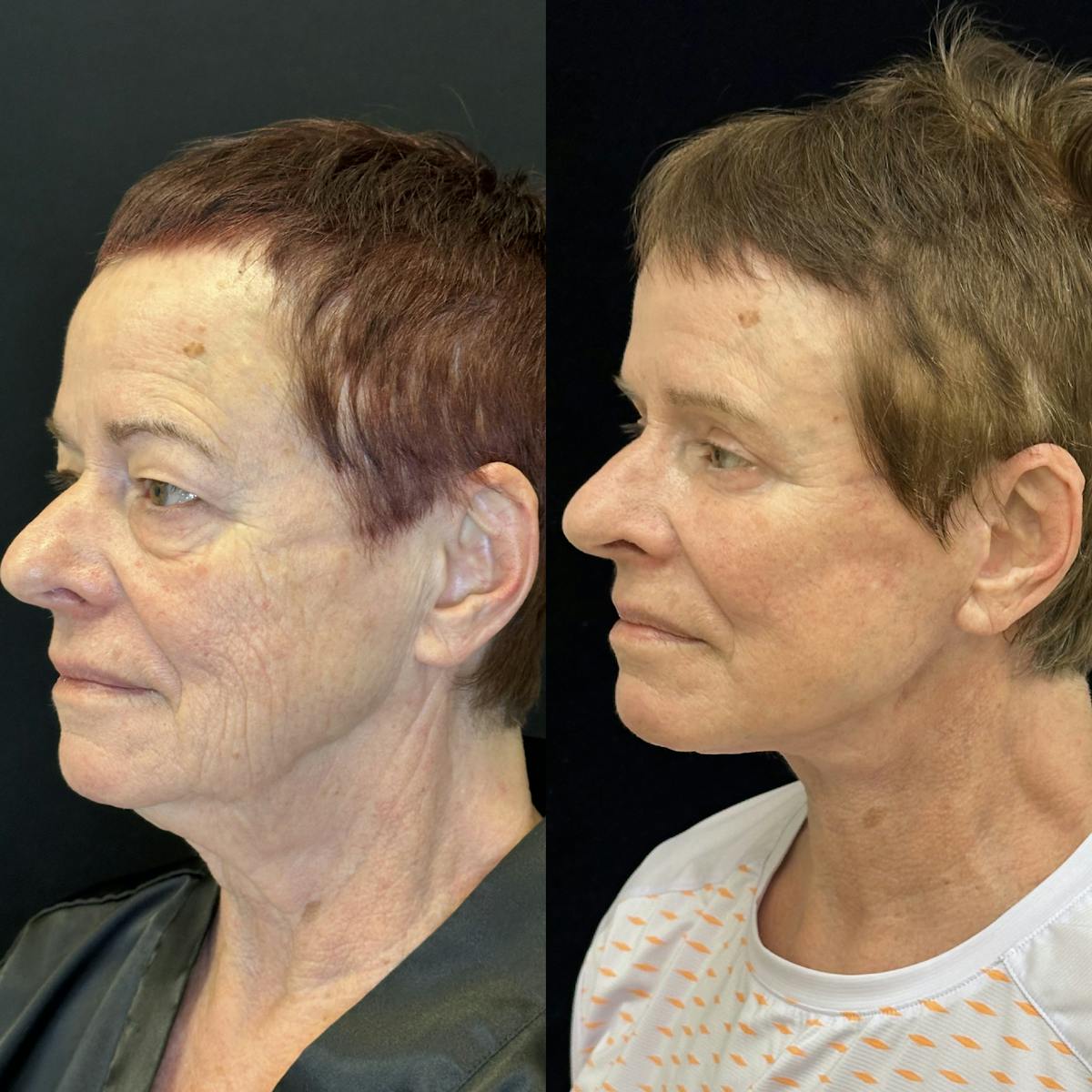 Lower Blepharoplasty Before & After Gallery - Patient 346693 - Image 3