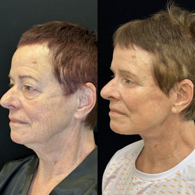 Deep Plane Facelift Before & After Gallery - Patient 579133 - Image 3