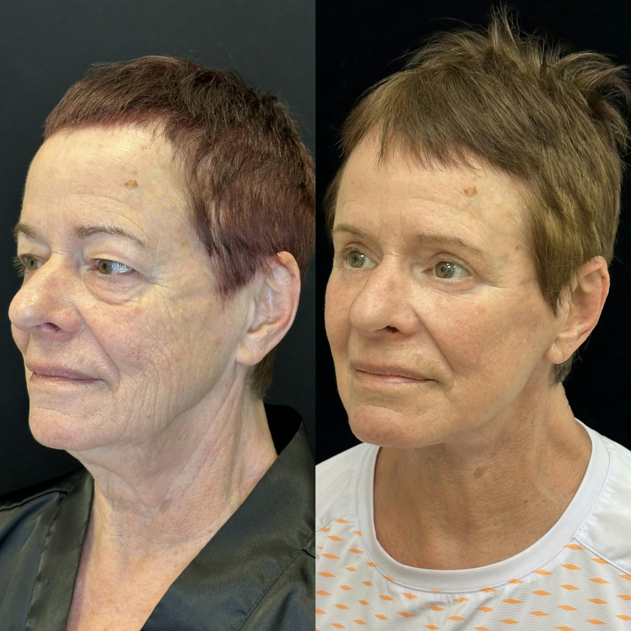  Upper Blepharoplasty Before & After Gallery - Patient 363295 - Image 1
