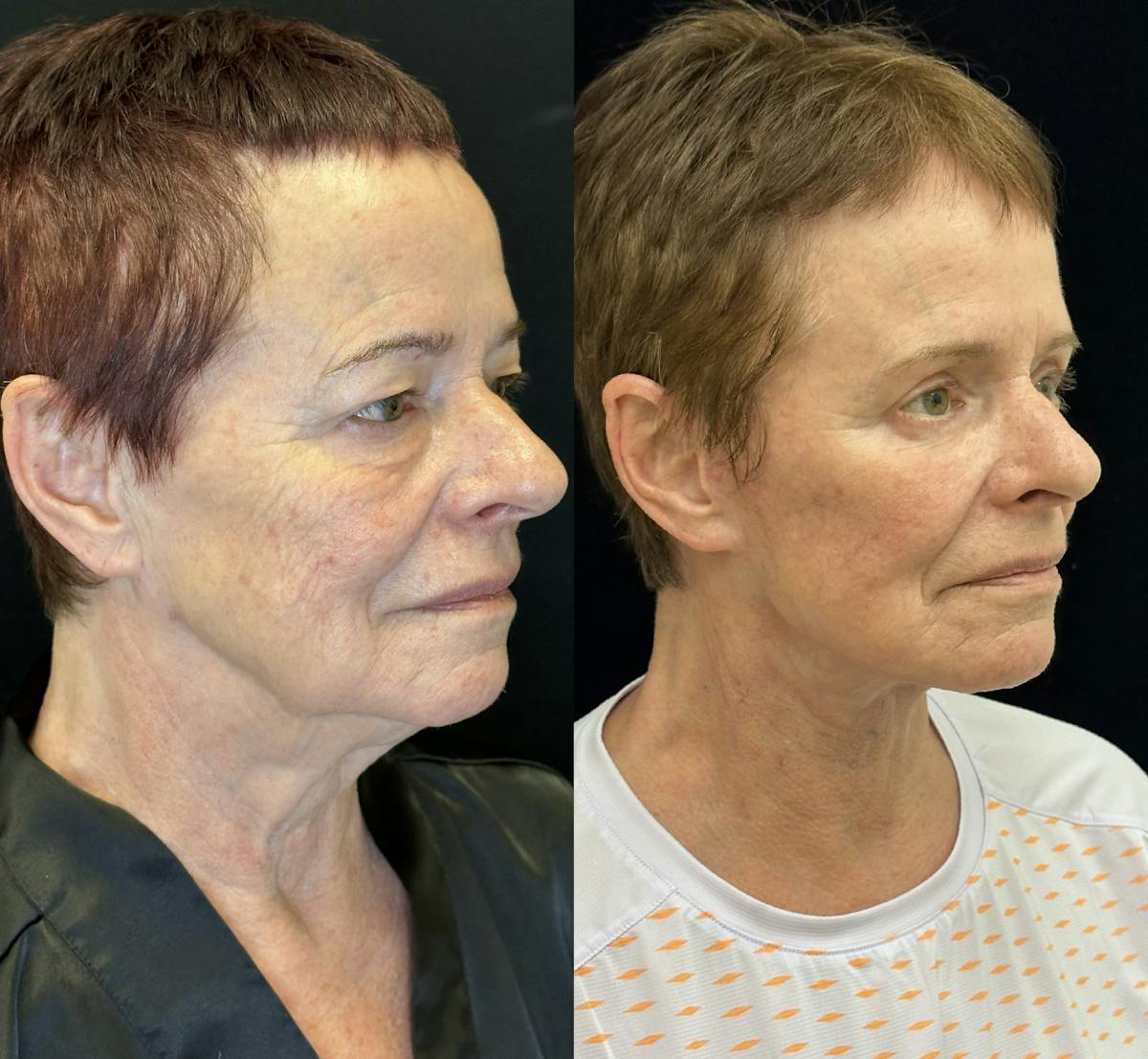 Lower Blepharoplasty Before & After Gallery - Patient 346693 - Image 5