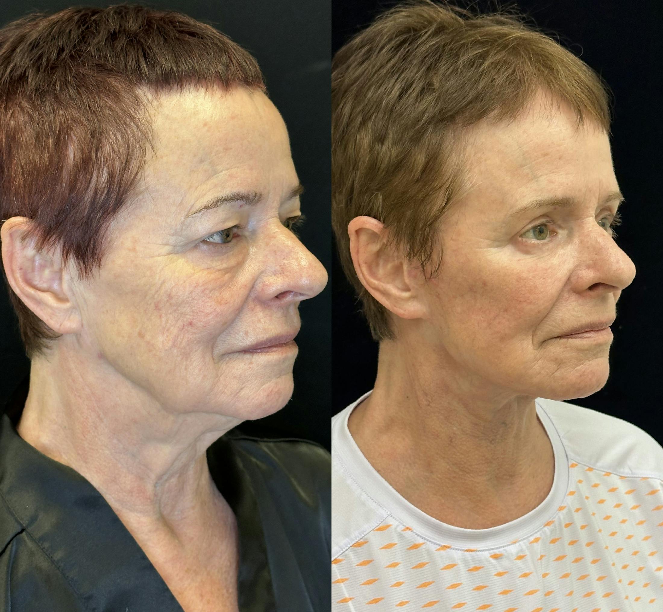 Deep Plane Facelift Before & After Gallery - Patient 579133 - Image 5