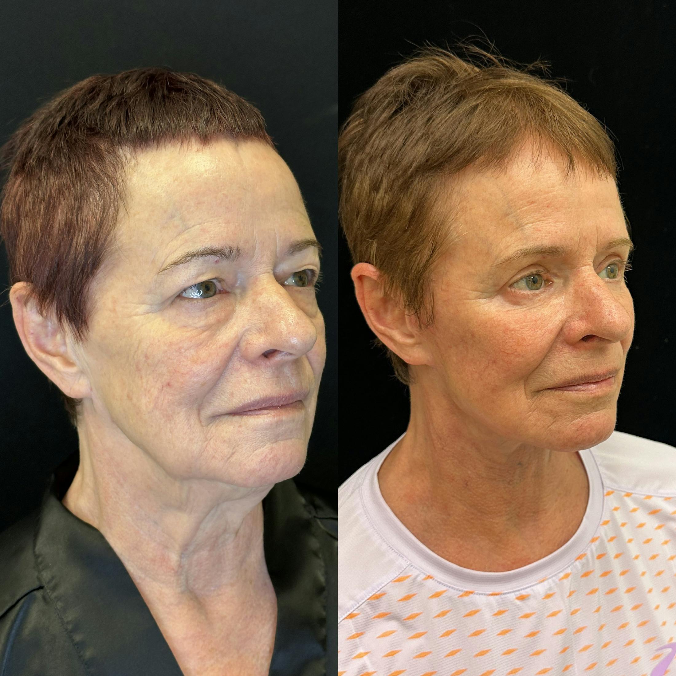 Deep Plane Facelift Before & After Gallery - Patient 579133 - Image 6