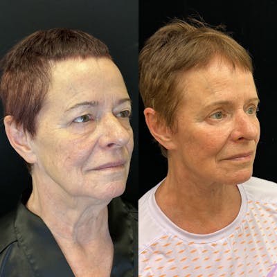 Deep Plane Facelift Before & After Gallery - Patient 579133 - Image 6